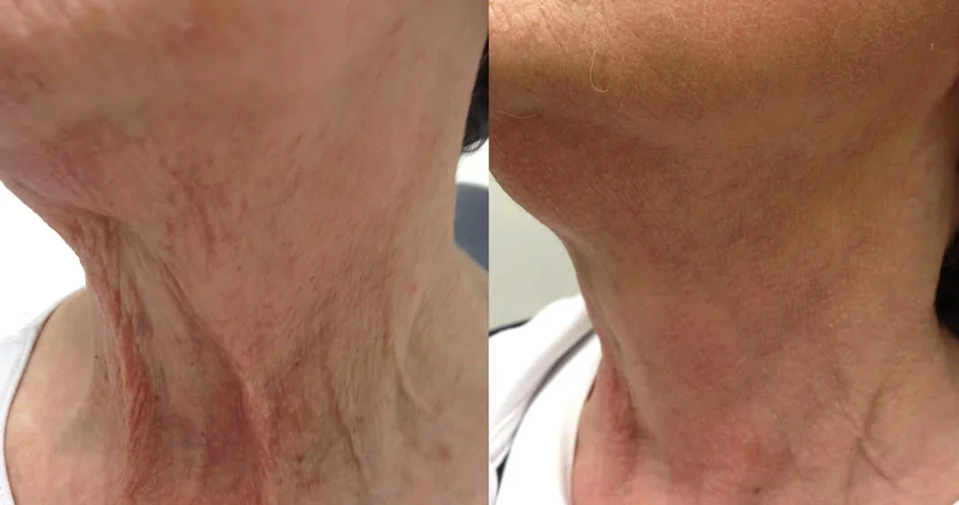 Before and after with XeiuC Collagen Oil